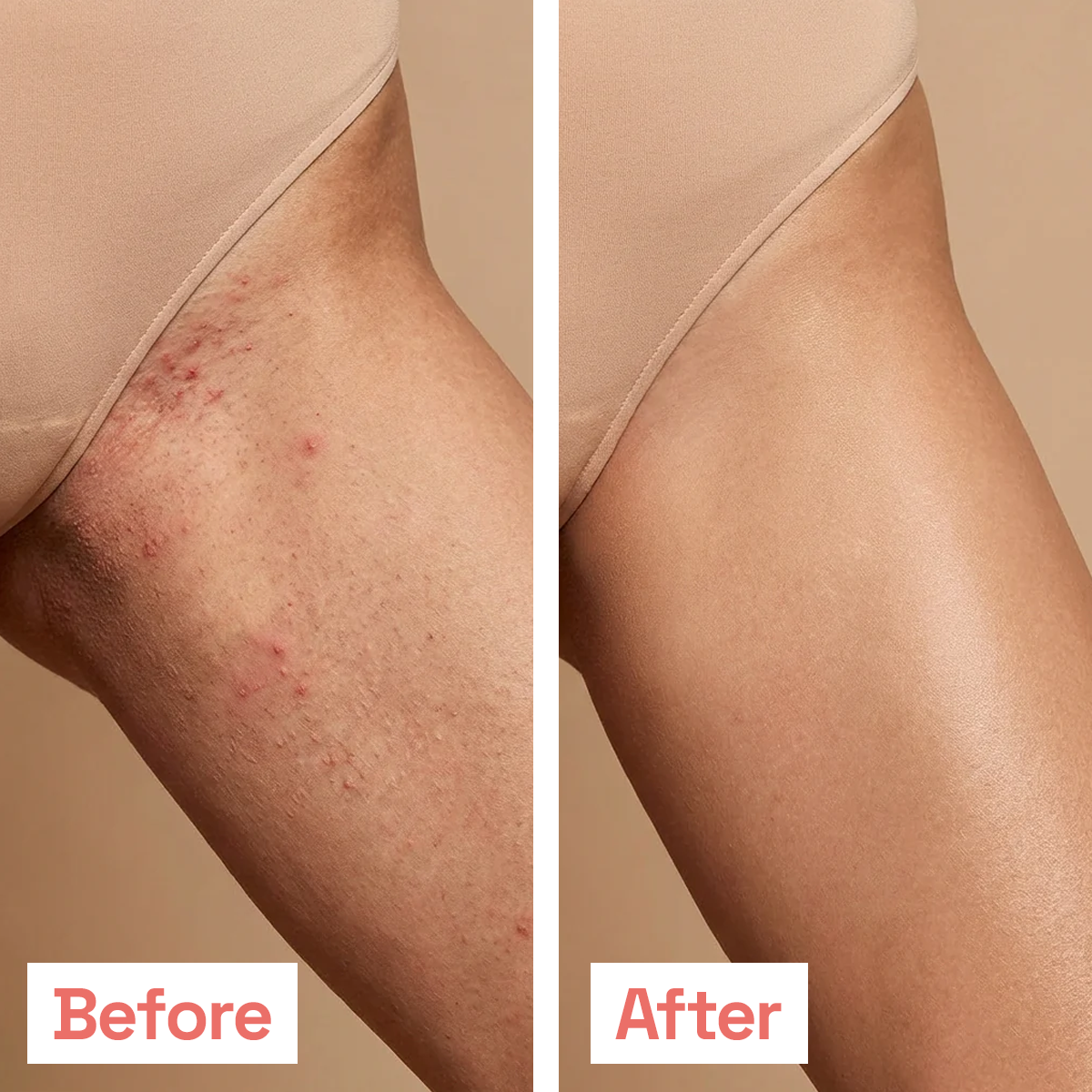 Smoothing Solution for Ingrown Hair