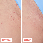 Smoothing Solution for Ingrown Hair