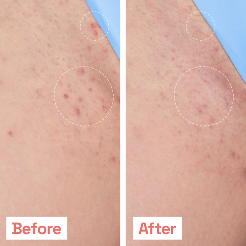 Smoothing Solution for Ingrown Hair
